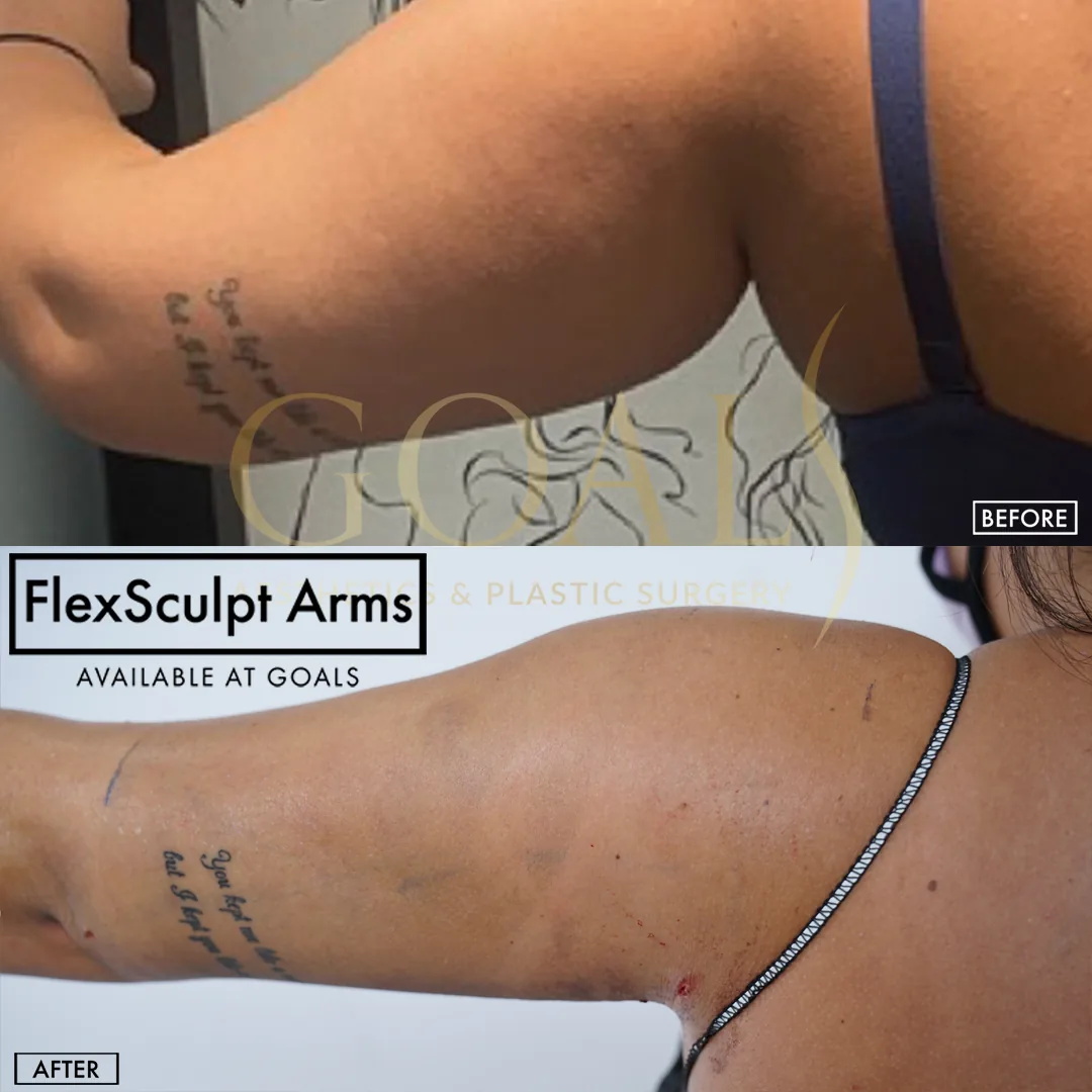 Before and after — Arm Contouring, patient 1