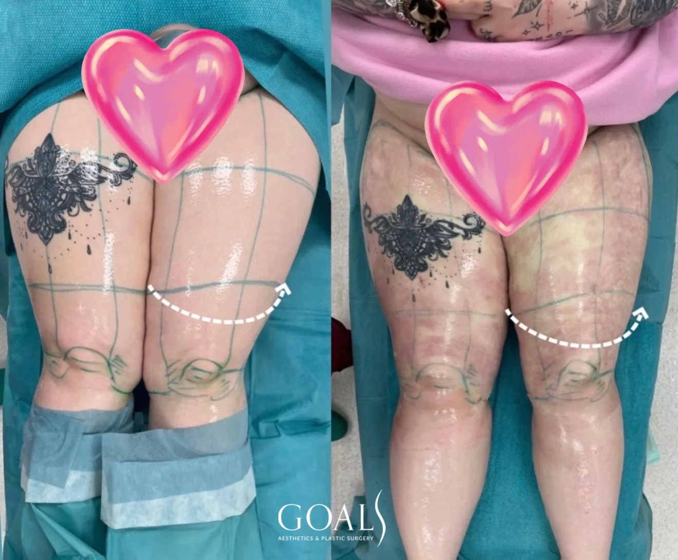Before and after — Arm Contouring, patient 2