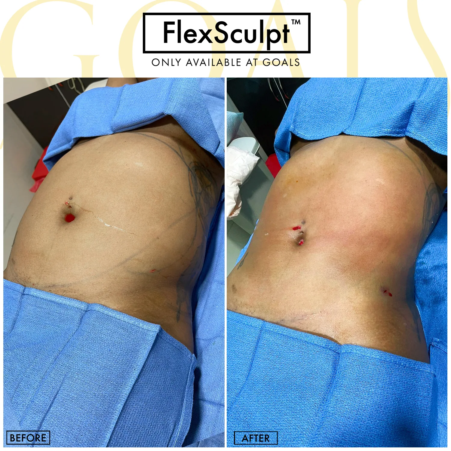 Before and after — Awake Liposuction with FlexSculpt · Philadelphia, patient 1