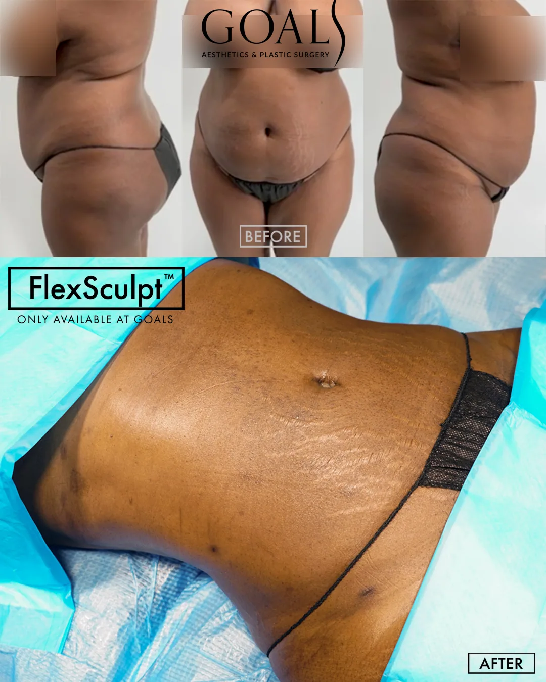 Before and after — Awake Liposuction with FlexSculpt · Philadelphia, patient 2