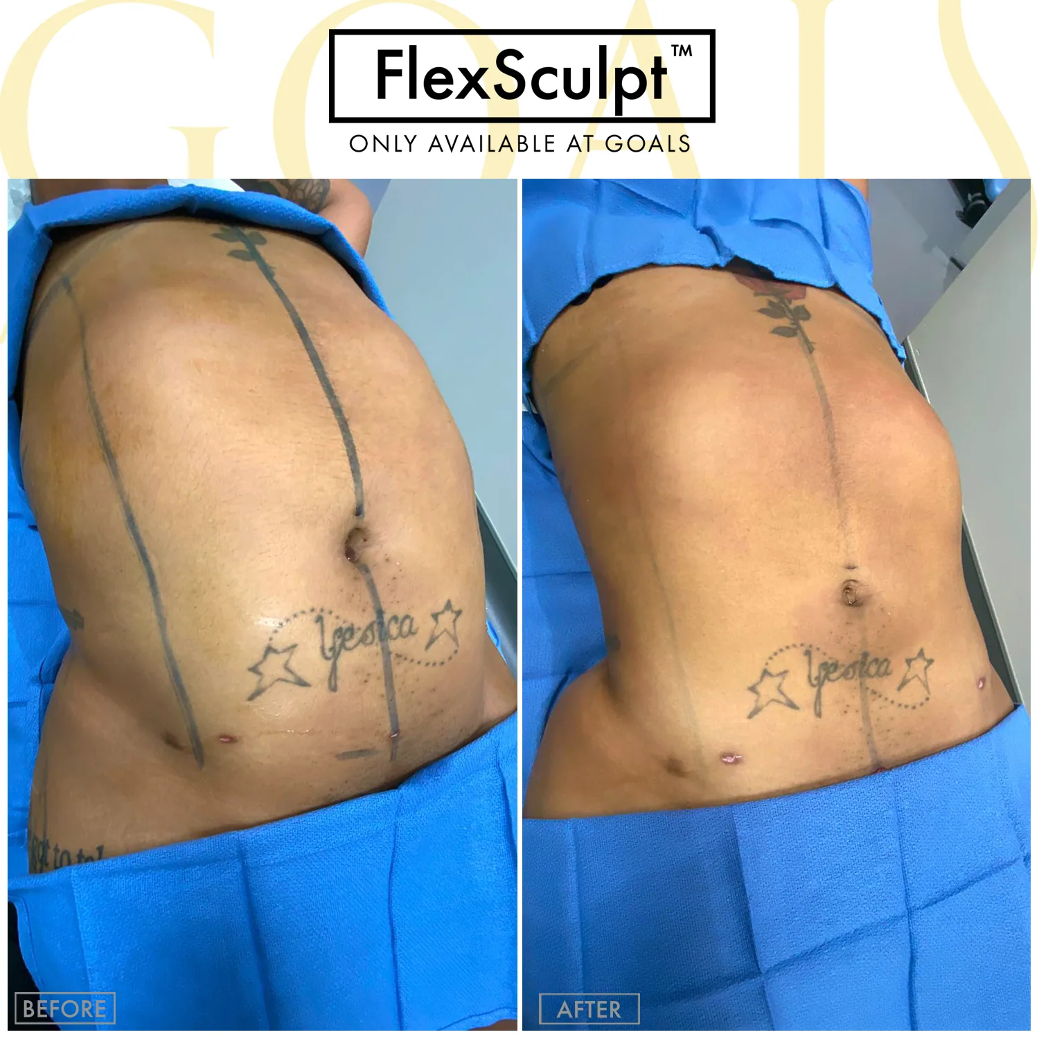 Before and after — Awake Liposuction with FlexSculpt · Philadelphia, patient 3