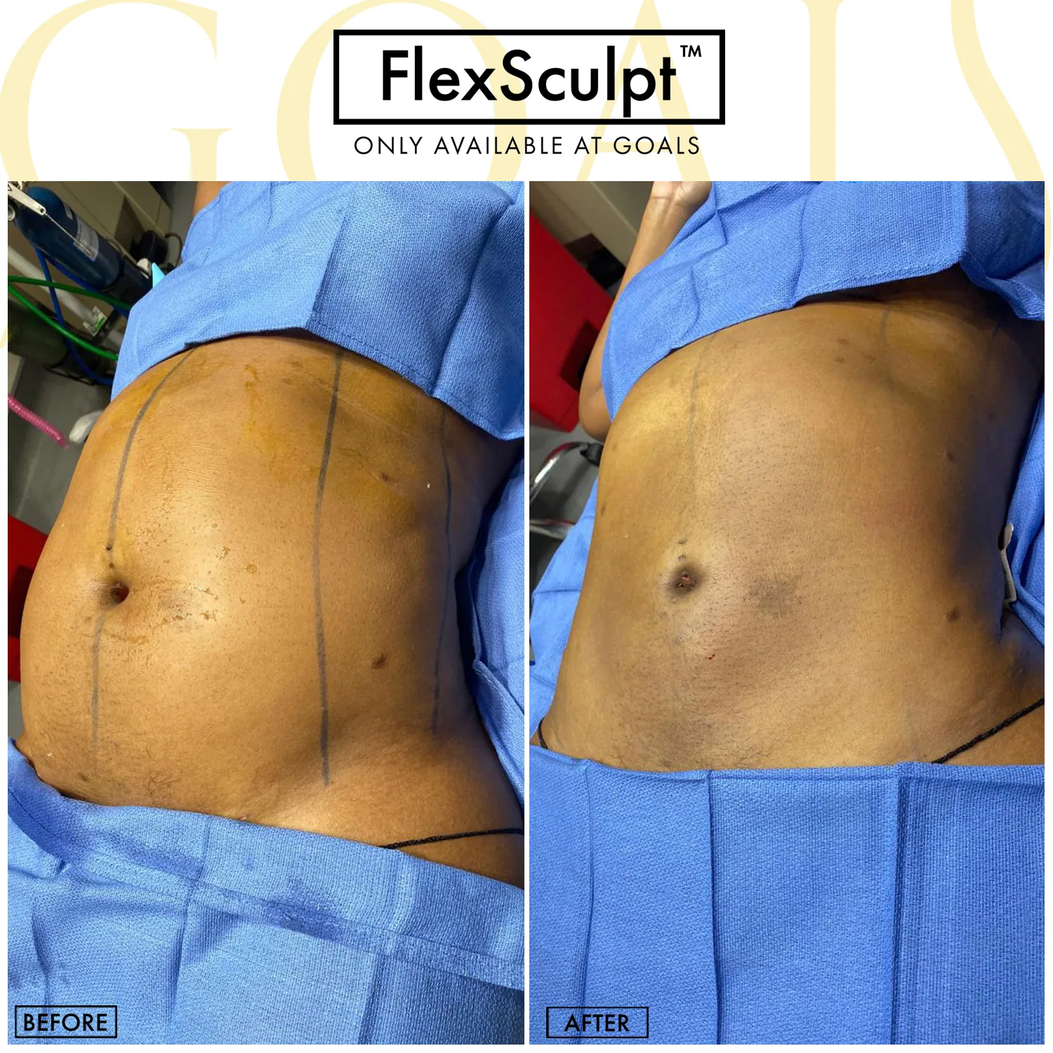 Before and after — Awake Liposuction with FlexSculpt · Philadelphia, patient 4