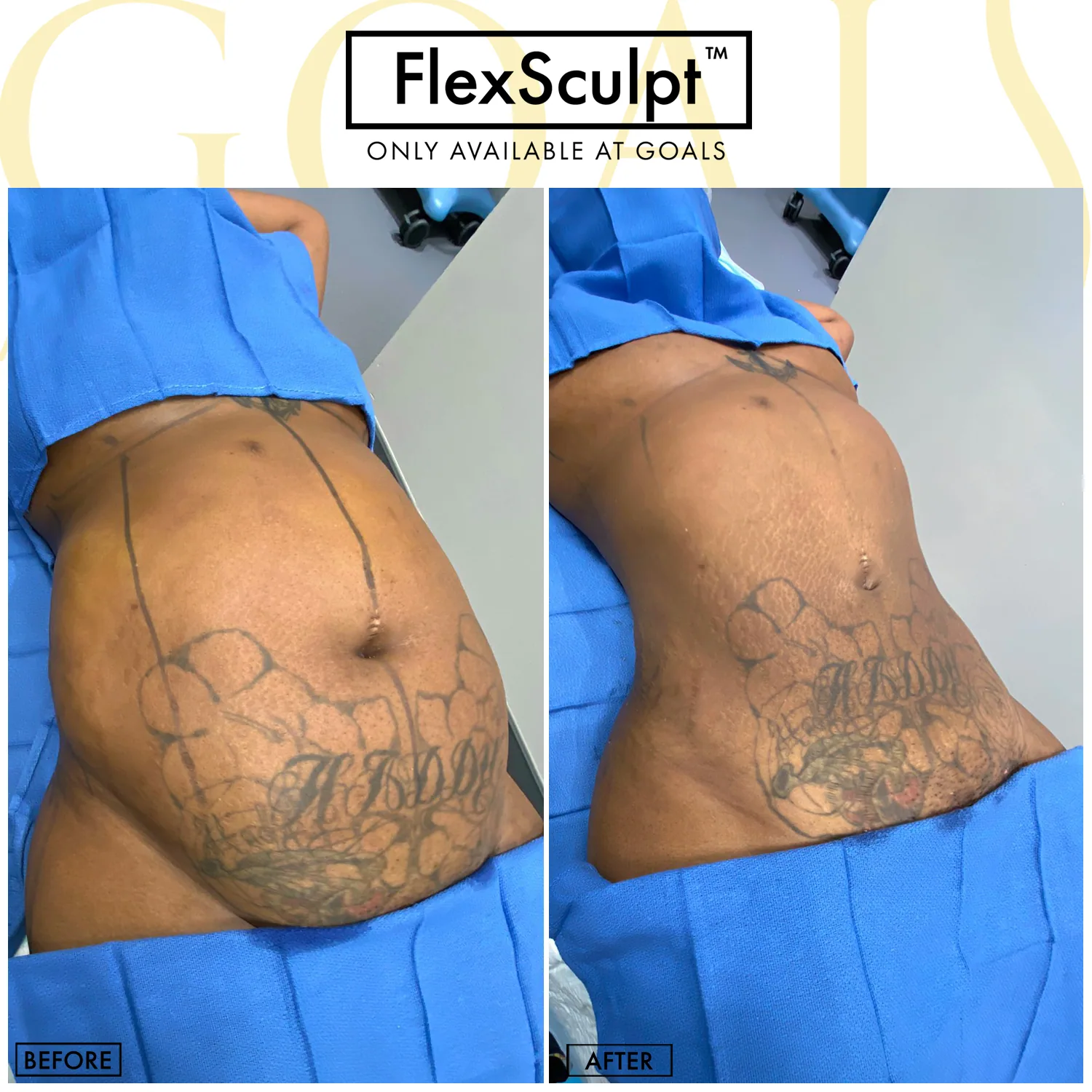 Before and after — Awake Liposuction with FlexSculpt · Philadelphia, patient 5