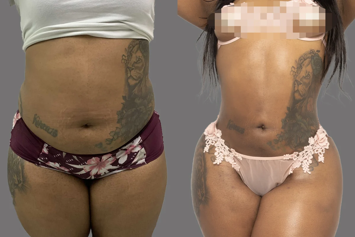 A Goals patient's awake liposuction result