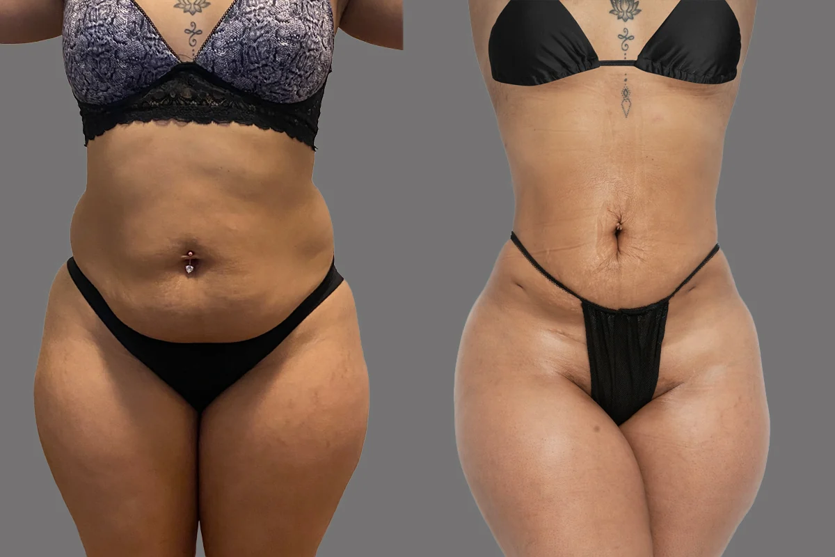 Before and after, patient 1