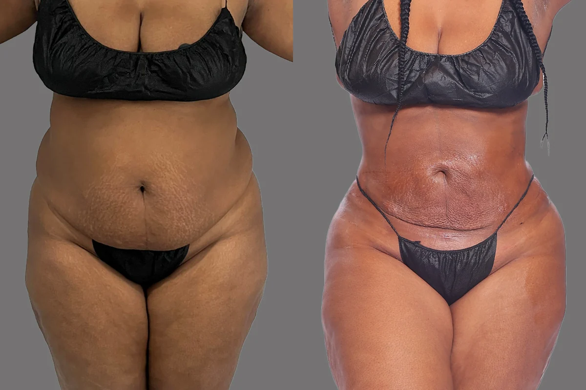 Before and after — Awake Liposuction with FlexSculpt · Brooklyn, patient 1