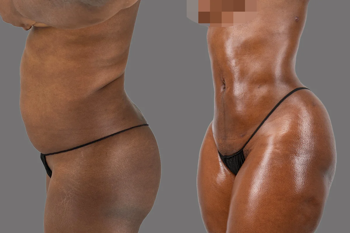 Before and after — Awake Liposuction with FlexSculpt · Brooklyn, patient 2