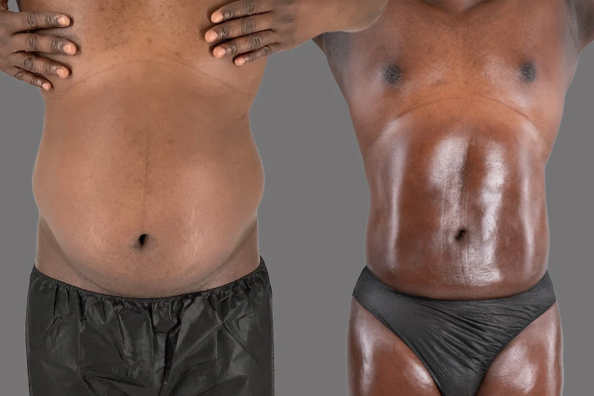 Before and after — Awake Liposuction with FlexSculpt · Brooklyn, patient 3