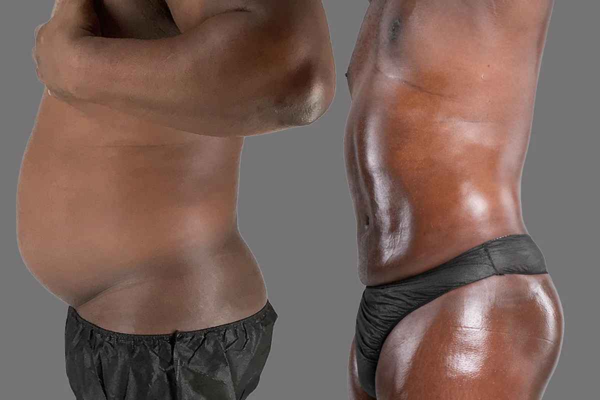 Before and after — Awake Liposuction with FlexSculpt · Brooklyn, patient 4