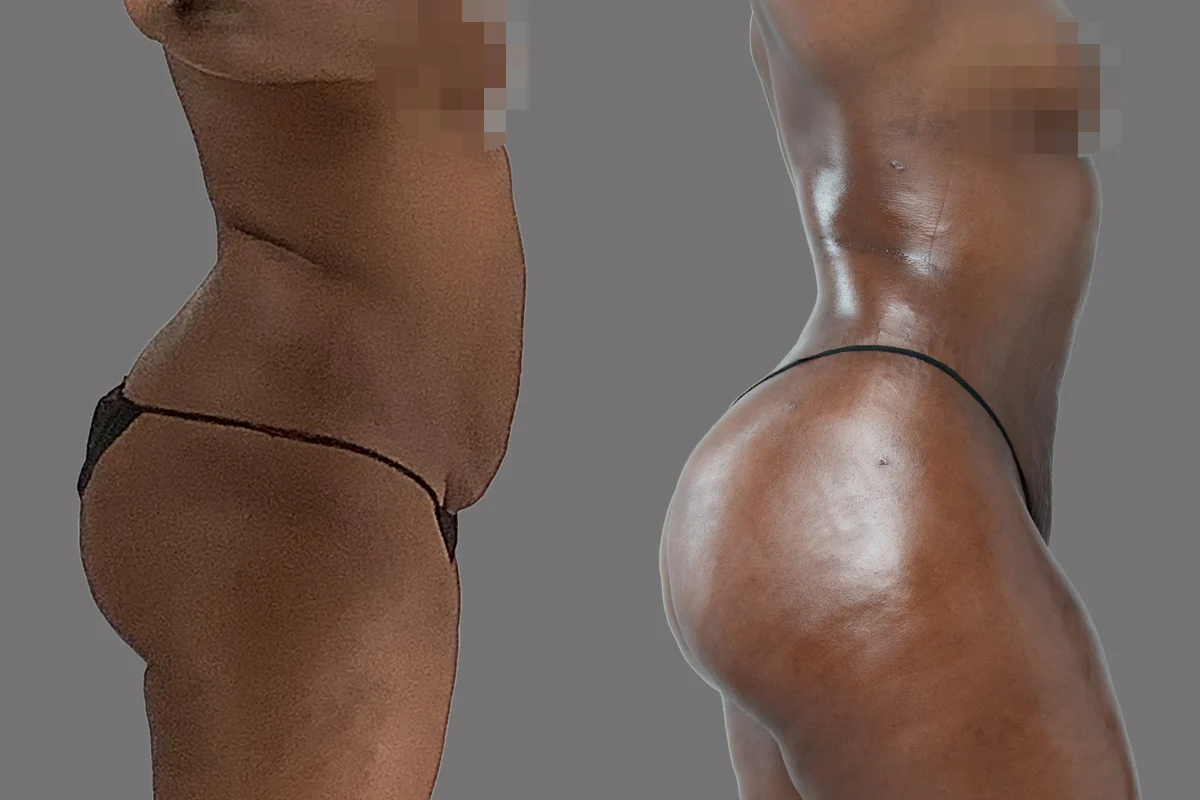 Before and after — Awake Liposuction with FlexSculpt · Brooklyn, patient 5