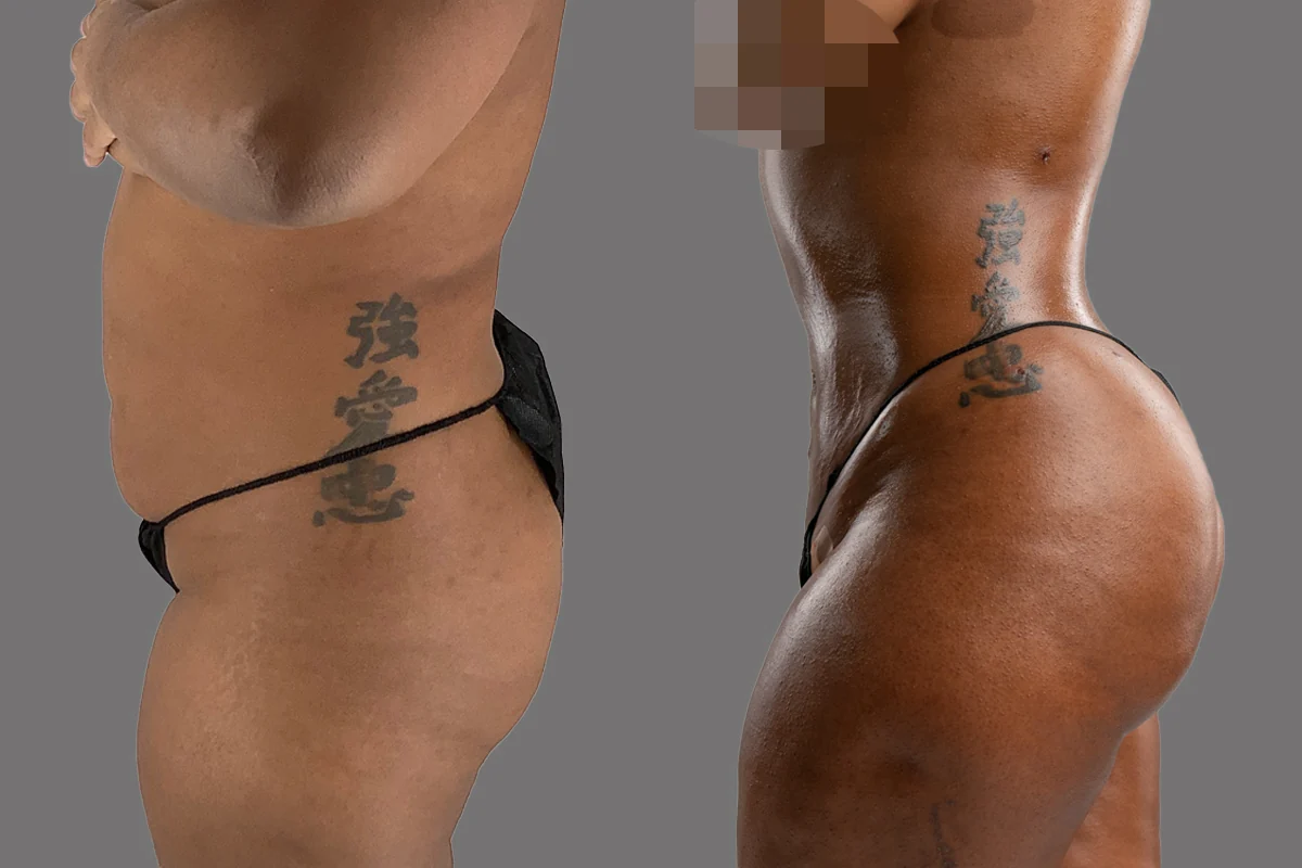 Before and after — Awake Liposuction with FlexSculpt · Brooklyn, patient 6