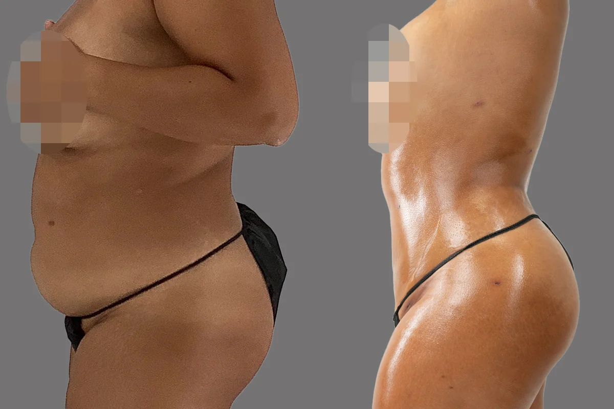 Before and after — Lipoescultura Despierta con FlexSculpt · Atlanta Tucker Rd., patient 4