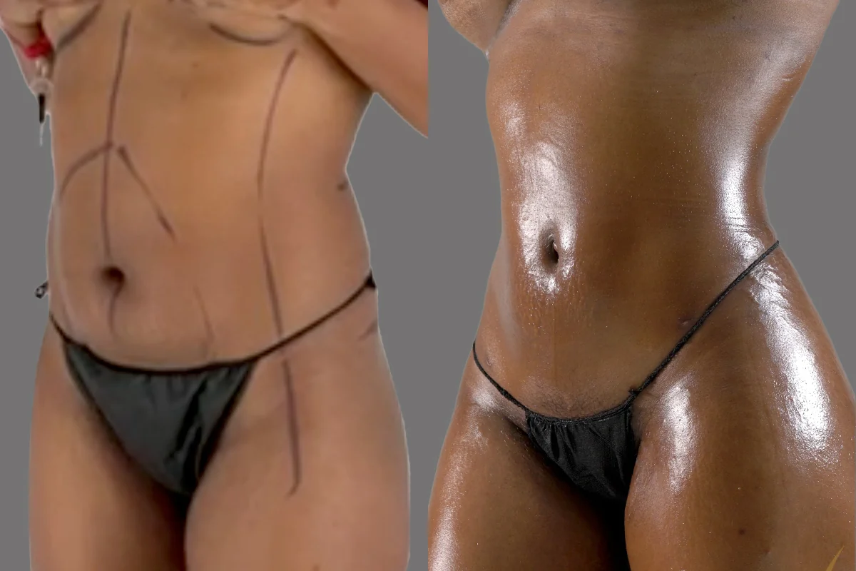 Before and after — Lipoescultura Despierta con FlexSculpt · Atlanta Tucker Rd., patient 5