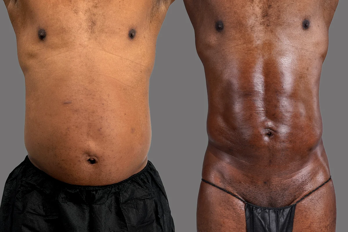 Before and after — Lipoescultura Despierta con FlexSculpt · Atlanta Tucker Rd., patient 6