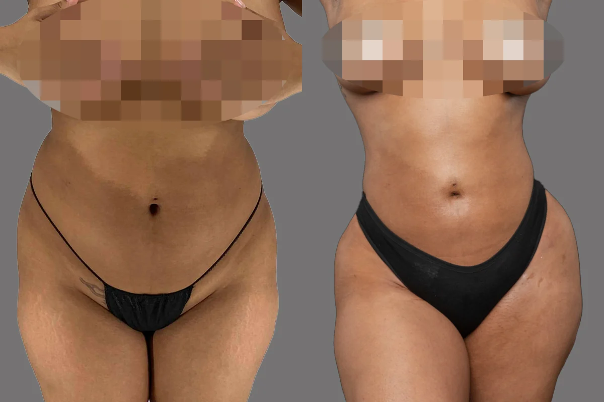 A Goals patient's awake liposuction result