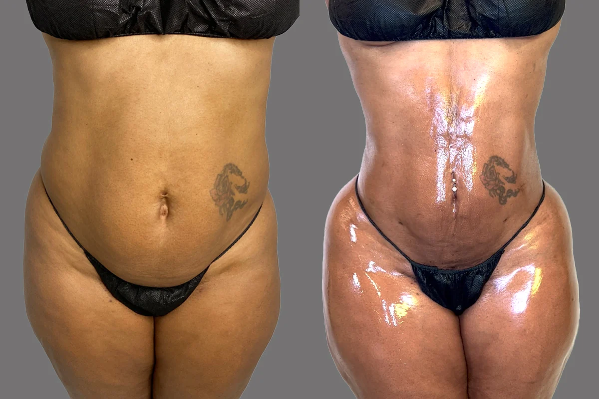 Before and after — Awake Liposuction with FlexSculpt · Bronx, patient 2