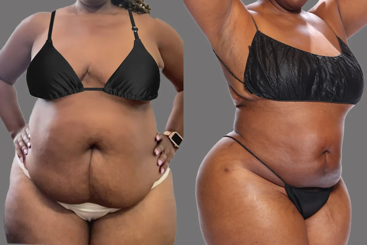 Before and after — Brooklyn, patient 2