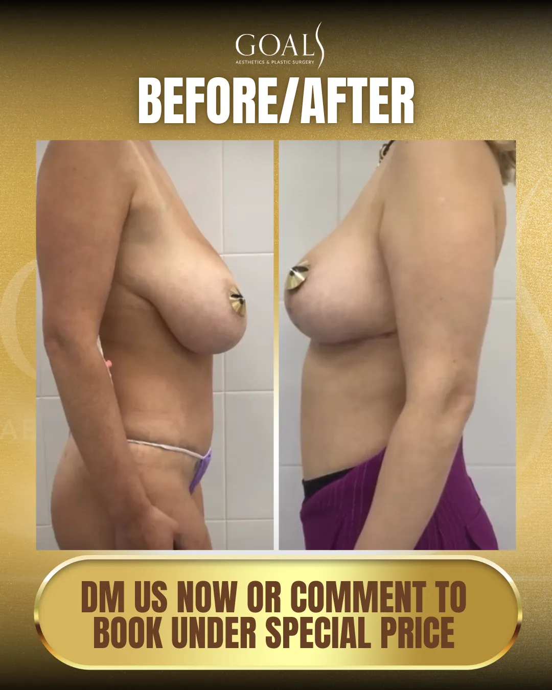 Before and after — Breast Augmentation, patient 2