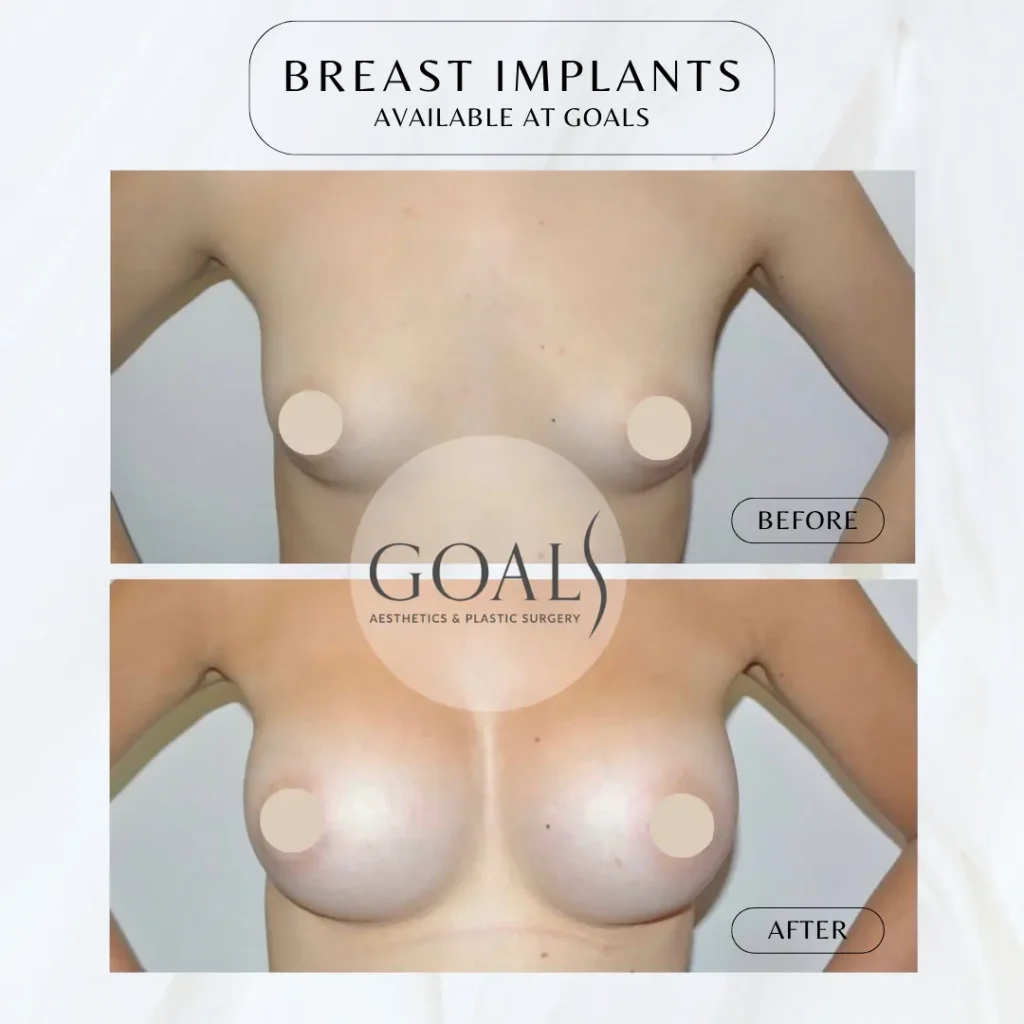 Before and after — Breast Augmentation, patient 3