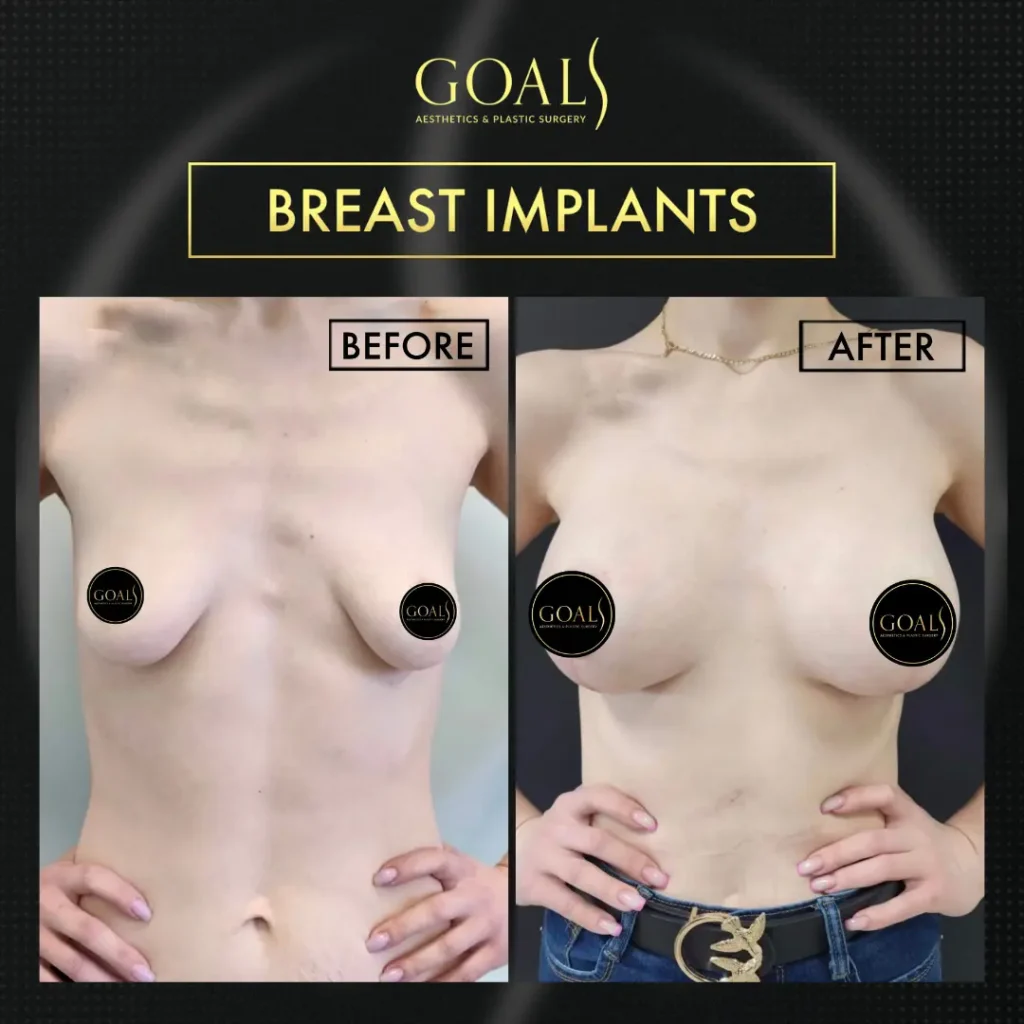 Before and after — Breast Augmentation, patient 5
