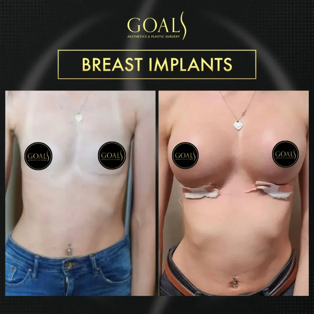 Before and after — Breast Augmentation, patient 6