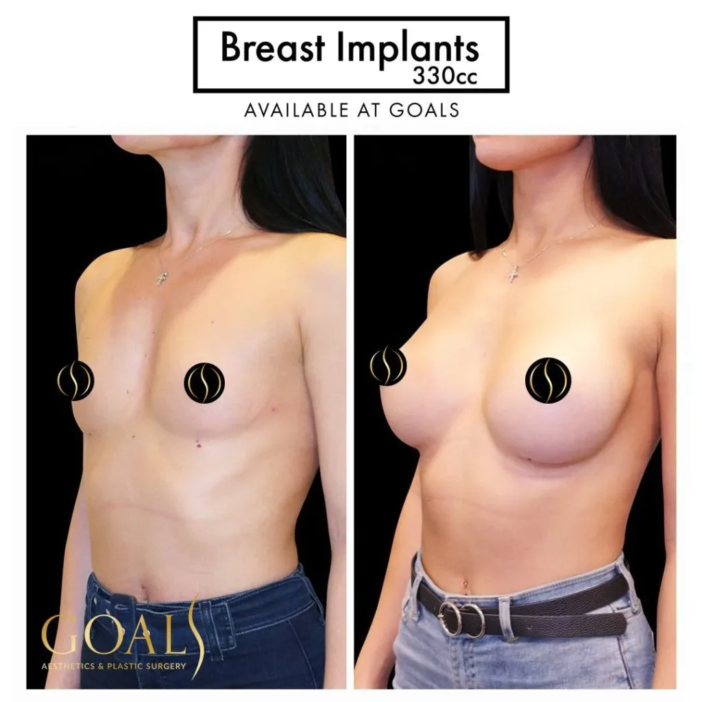 Breast Augmentation — patient result