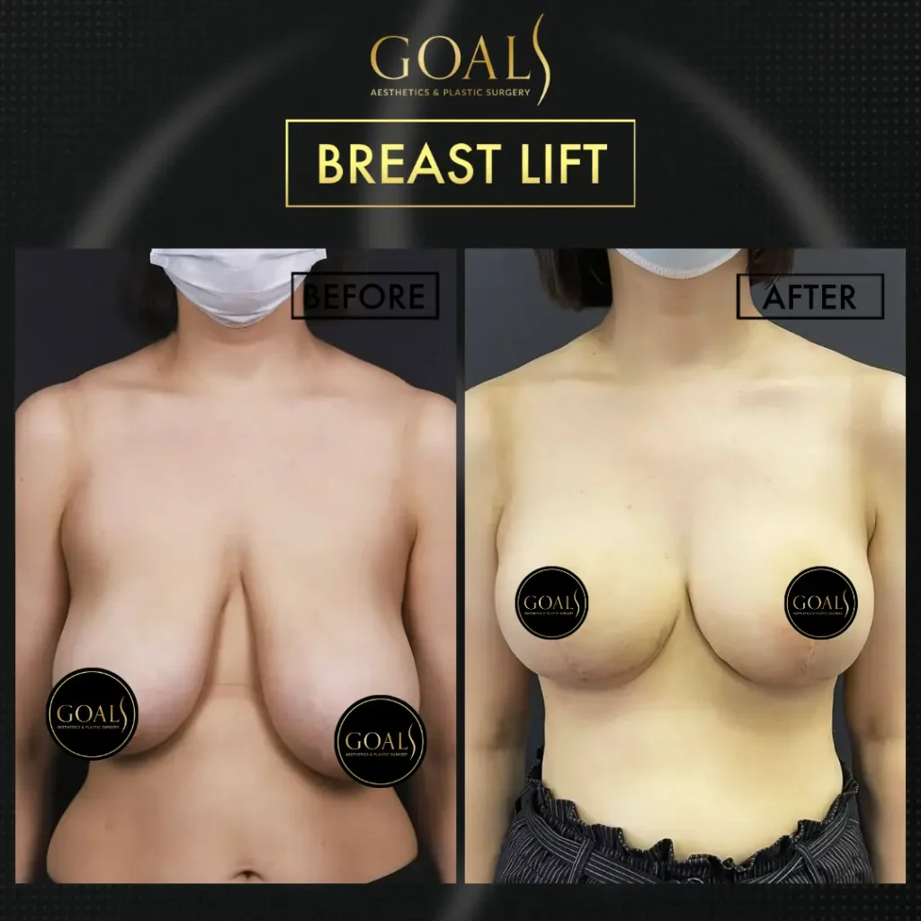 Before and after — Breast Augmentation · Houston, patient 1