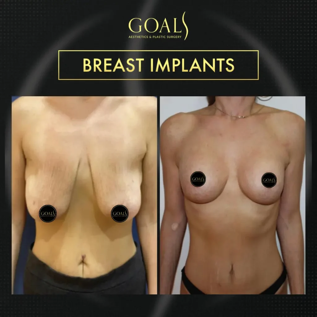Before and after — Breast Augmentation · Houston, patient 3