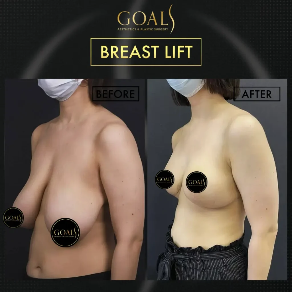 Before and after — Breast Augmentation · Houston, patient 4