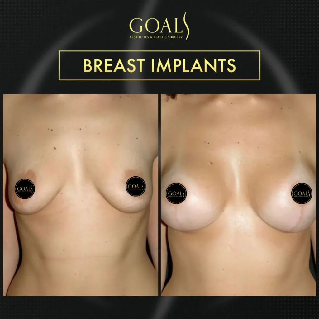 Before and after — Breast Augmentation · Houston, patient 5