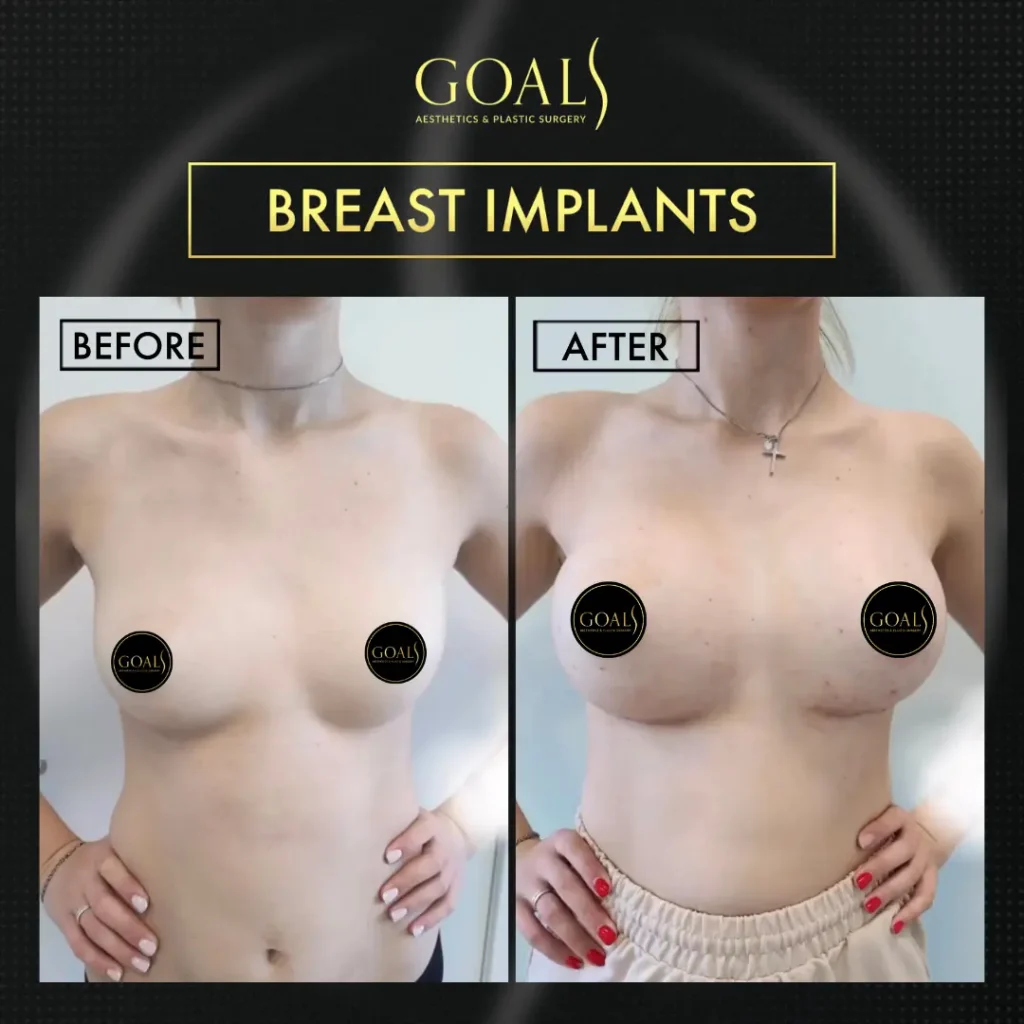Before and after — Breast Augmentation · Houston, patient 6