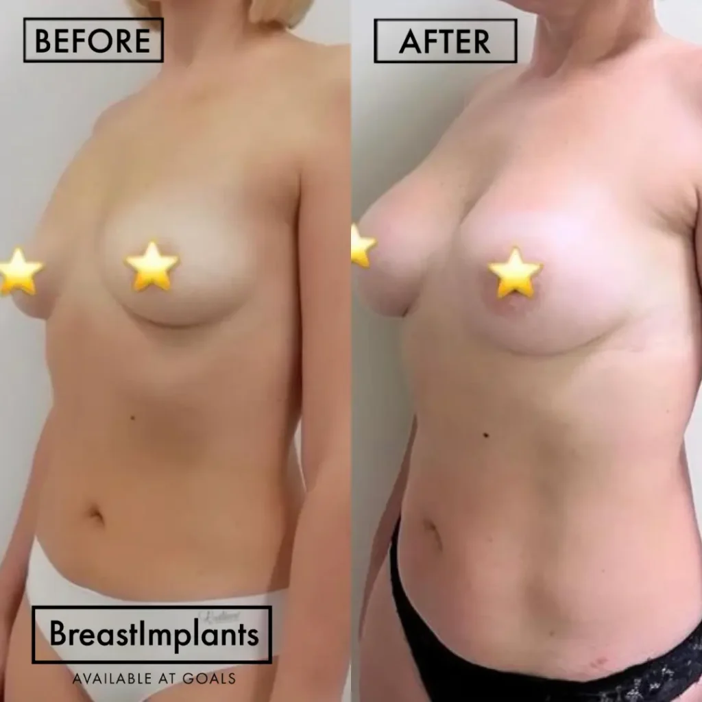 Before and after — Breast Augmentation · Los Angeles, patient 6