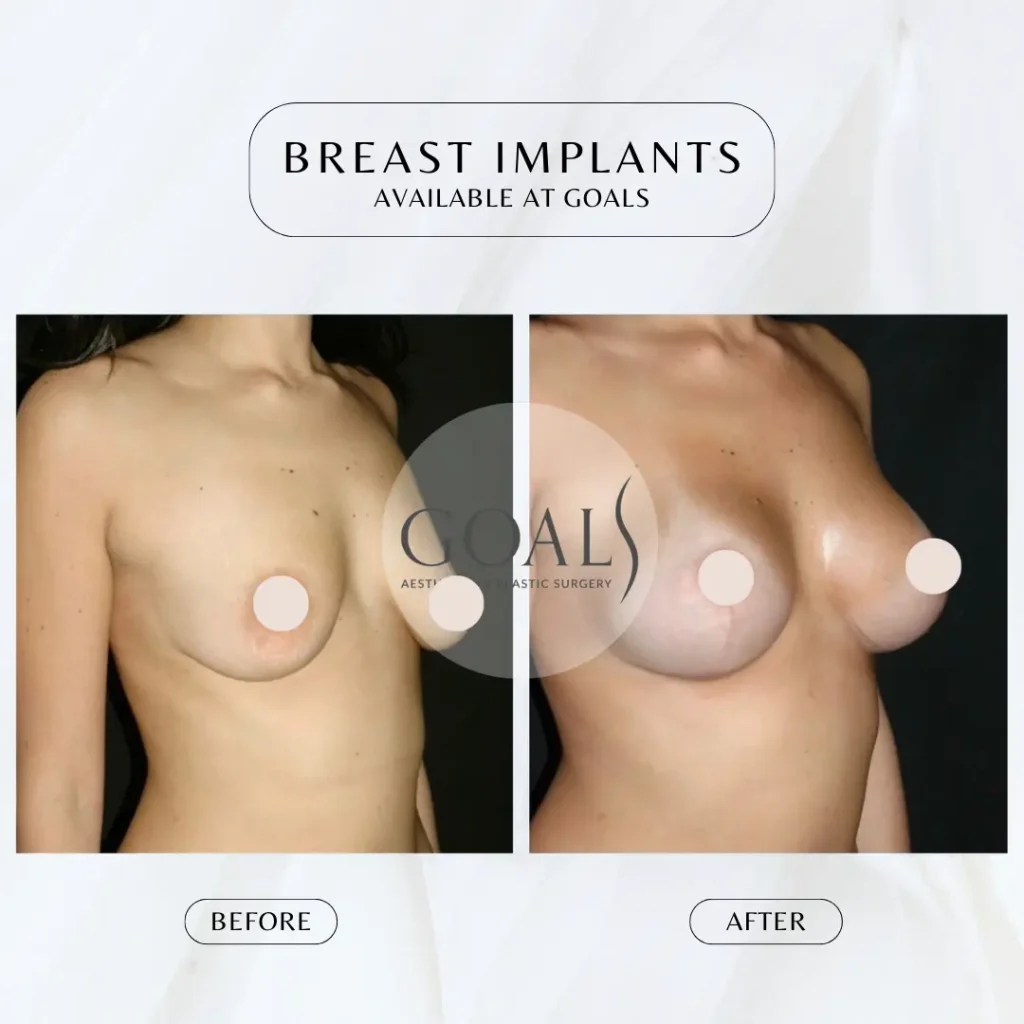 Before and after — Breast Augmentation, patient 1