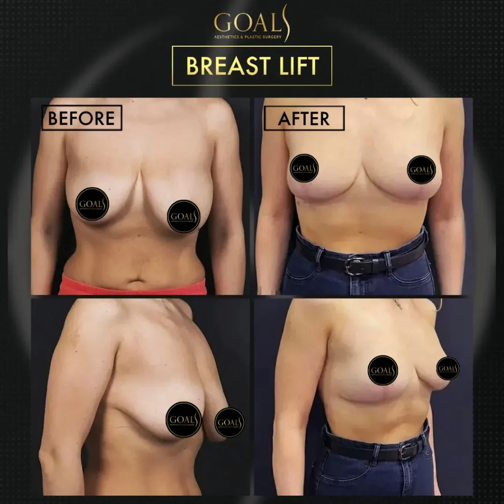 Before and after — Breast Augmentation, patient 2