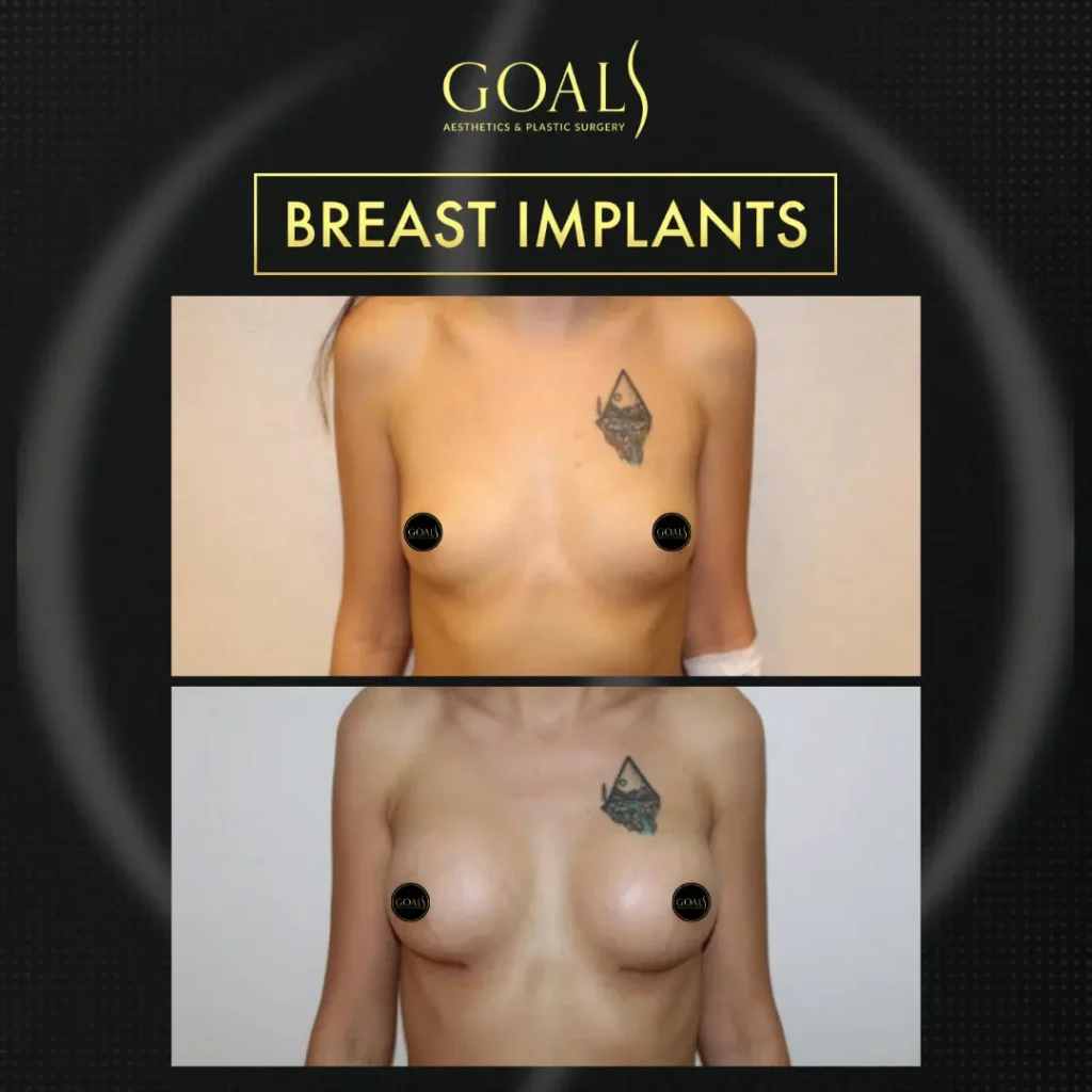 Before and after — Breast Augmentation, patient 4