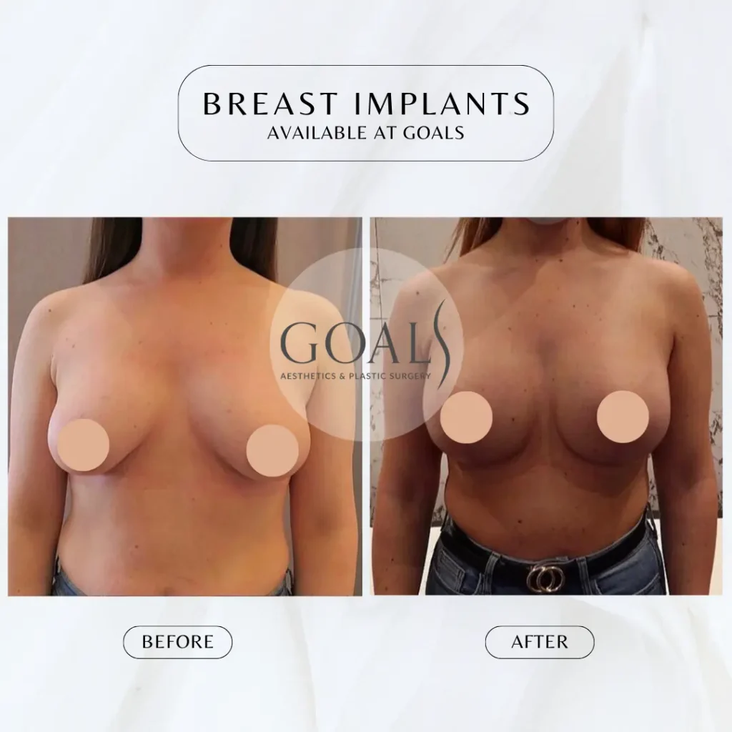 Before and after — Breast Augmentation, patient 5