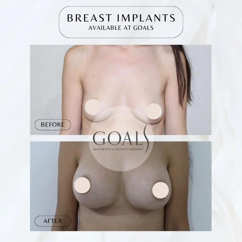 Before and after — Breast Augmentation, patient 6