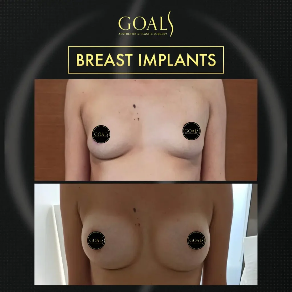Before and after — Breast Augmentation · Bronx, patient 4