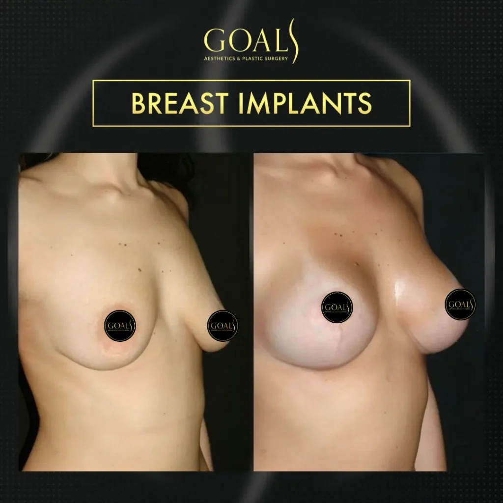 Before and after — Breast Augmentation · Bronx, patient 5