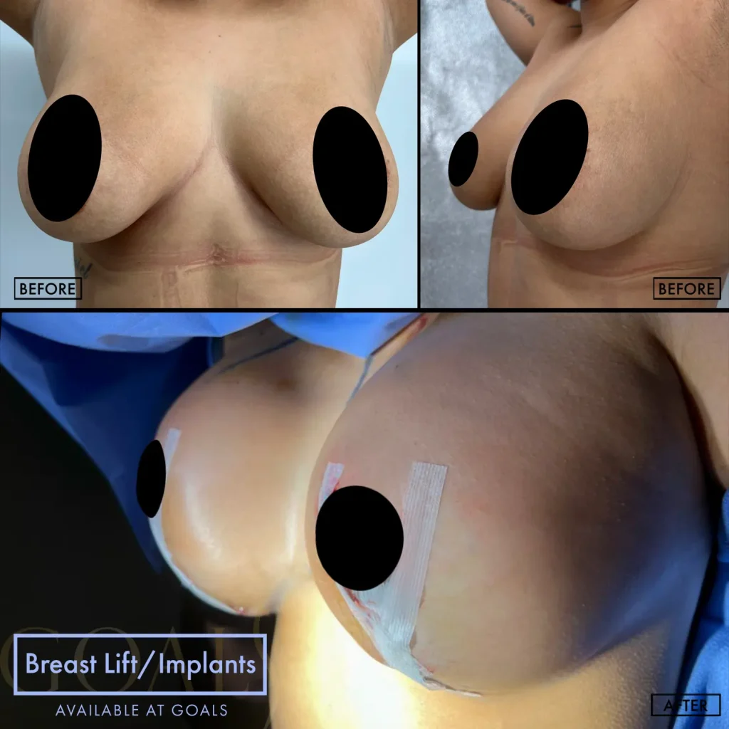 Before and after — Breast Augmentation · Bronx, patient 6