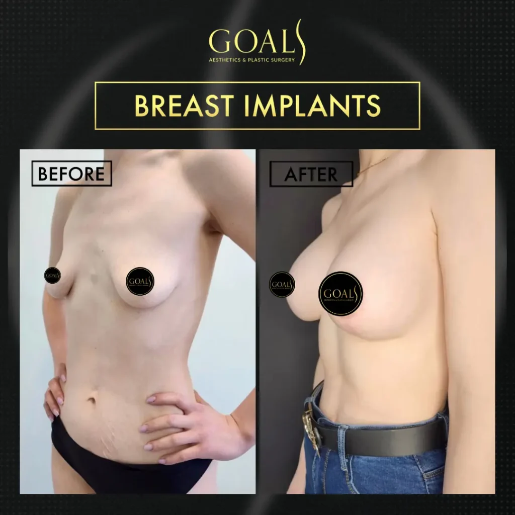 Before and after — Breast Augmentation · Brooklyn, patient 2