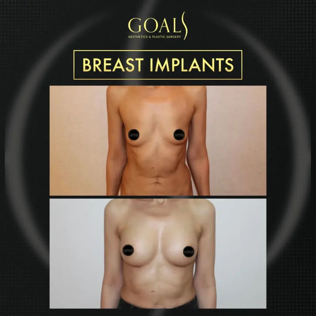 Before and after — Breast Augmentation · Brooklyn, patient 3