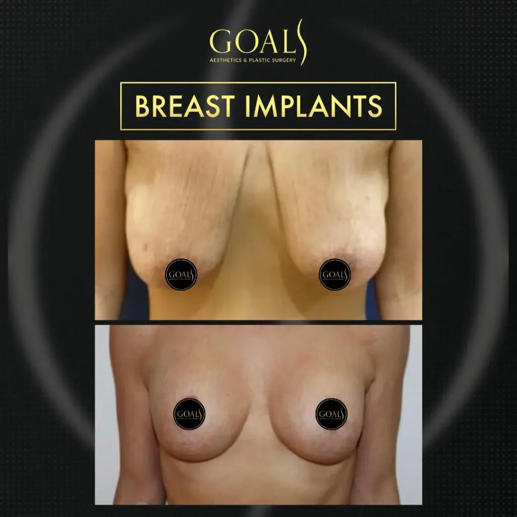 Before and after — Breast Augmentation, patient 1