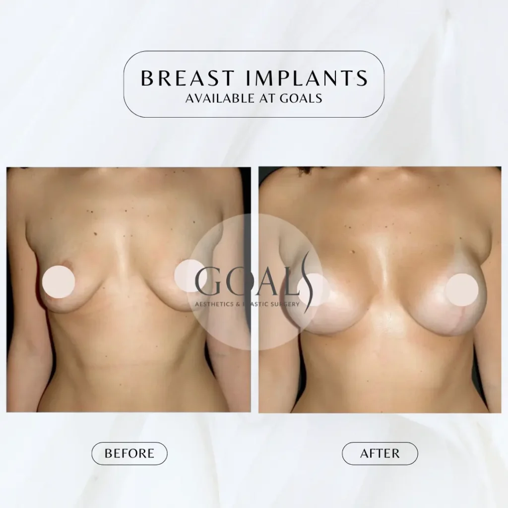 Before and after — Breast Augmentation, patient 2