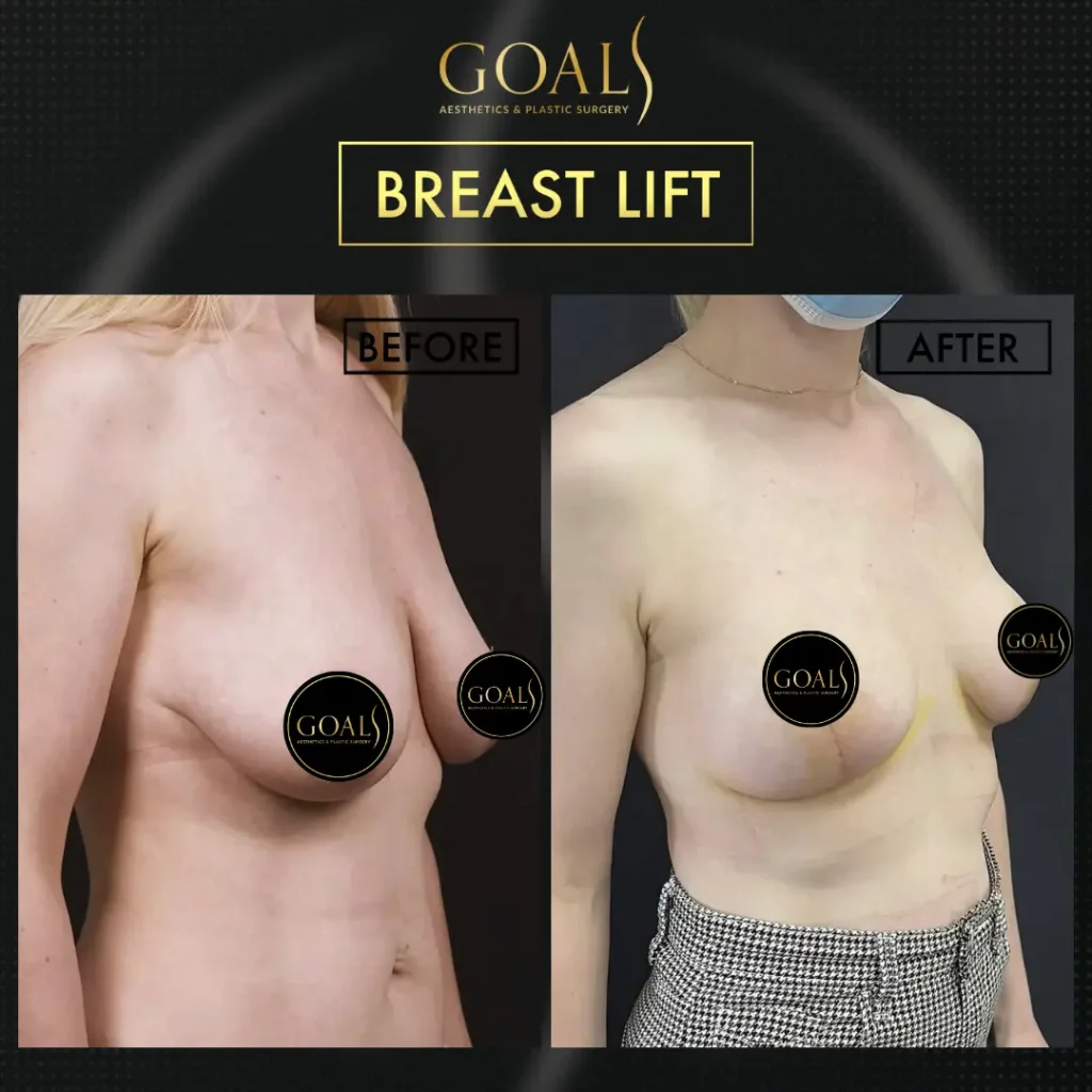 Before and after — Breast Augmentation, patient 3