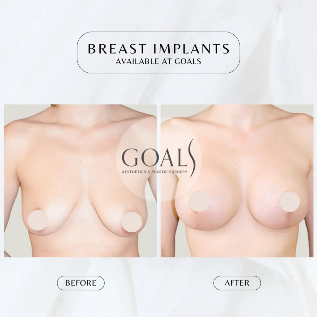 Before and after — Breast Augmentation, patient 4