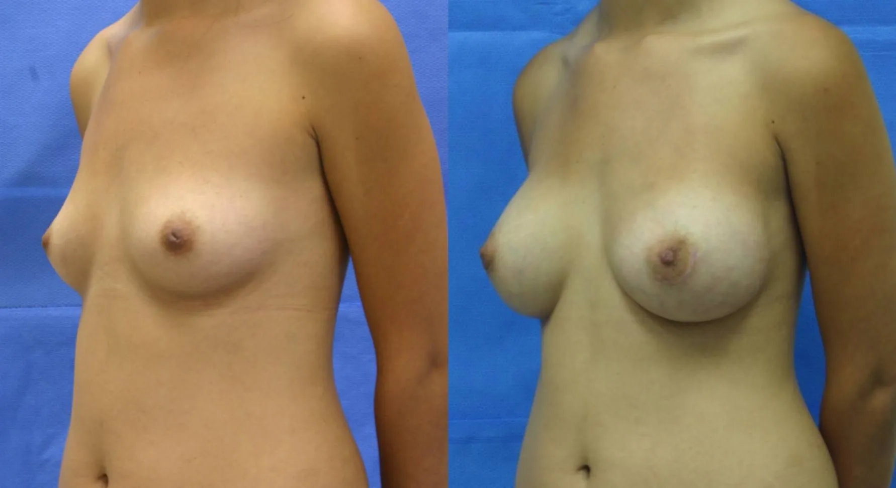 Breast Augmentation — patient result