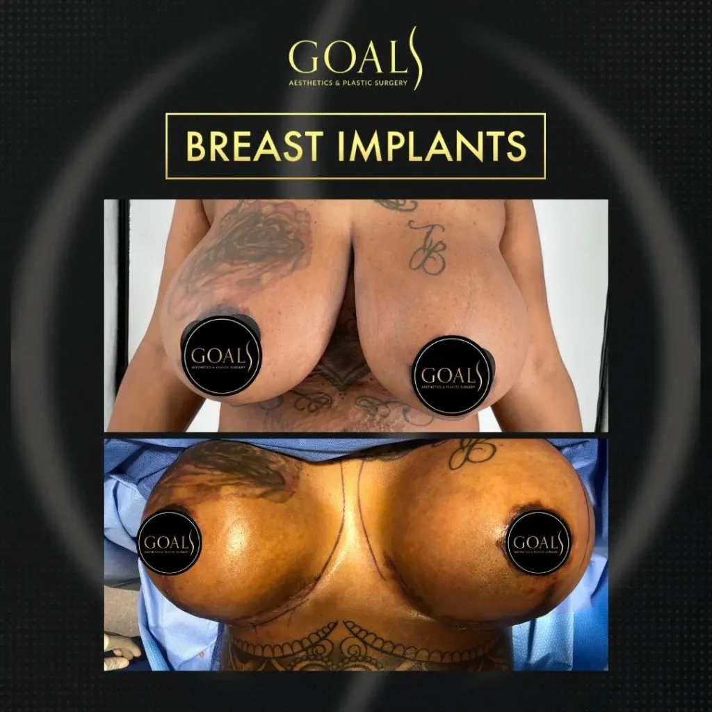 Breast Augmentation — patient result