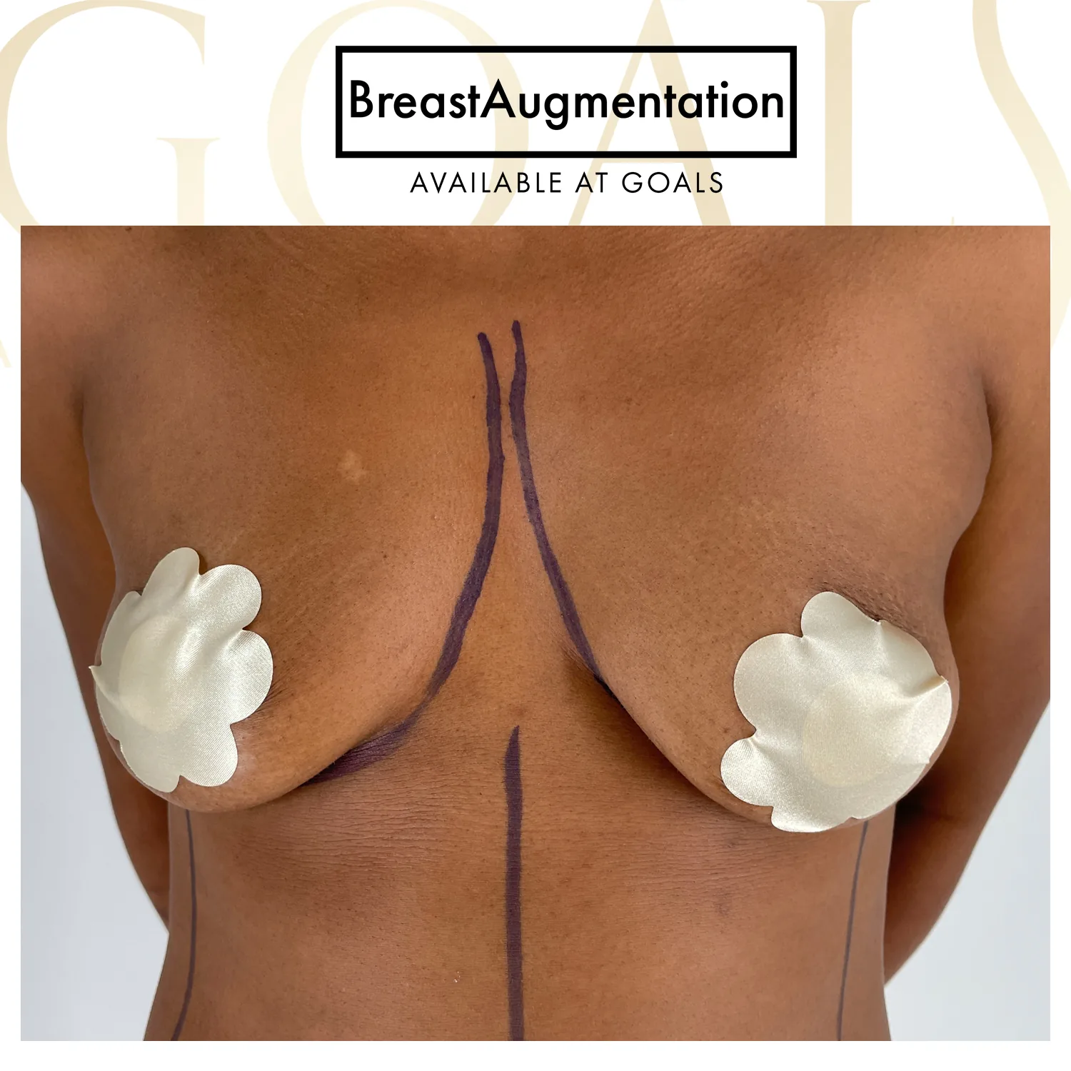 Before and after — Breast Augmentation, patient 3