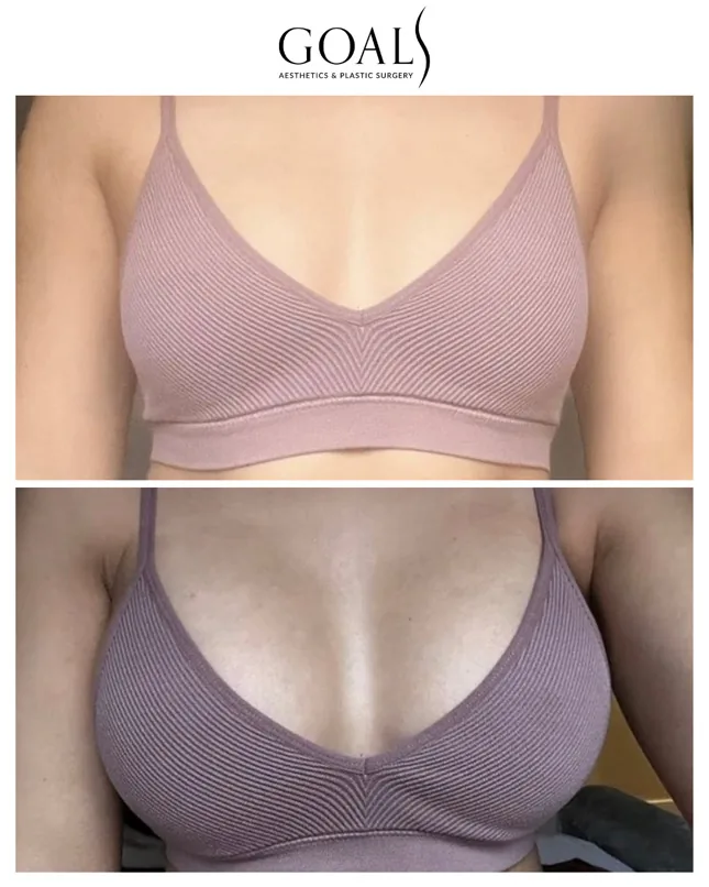 Before and after — Breast Augmentation, patient 4